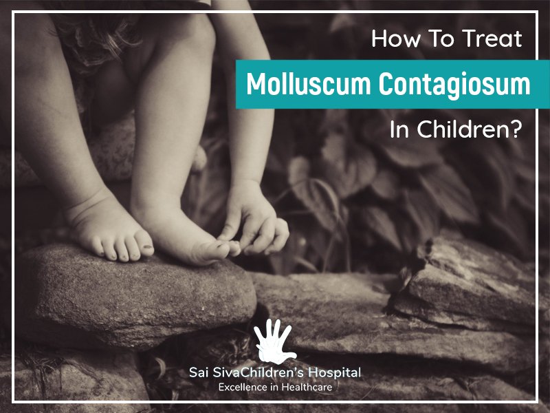 How To Treat Molluscum Contagiosum In Children?
